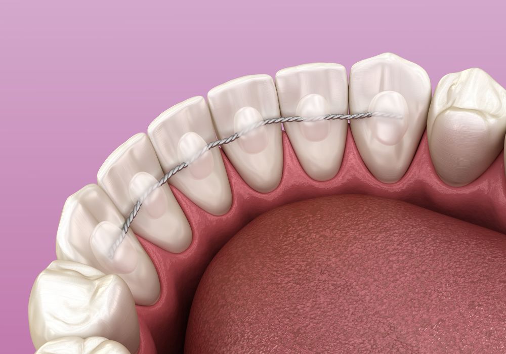 Contention orthodontique au Cabinet Dentaire Houdinois