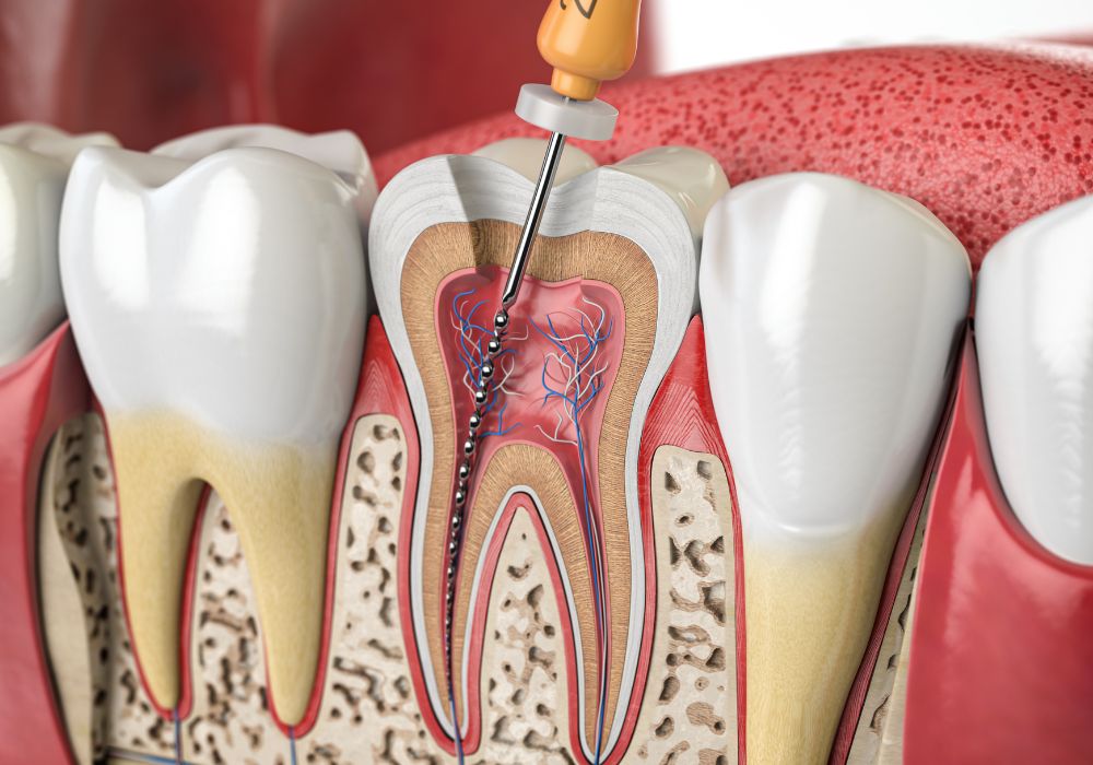Soin d'endodontie au Cabinet Dentaire Houdinois