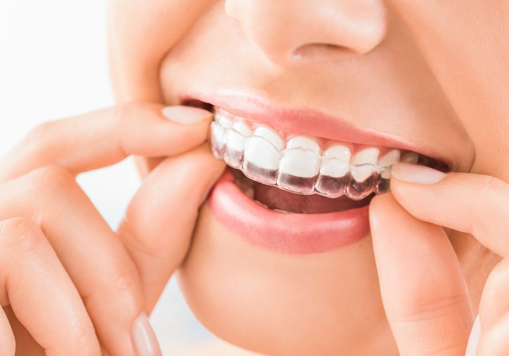 Gouttière d'orthodontie invisible