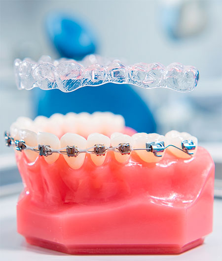 Orthodontie au Cabinet Dentaire Houdinois